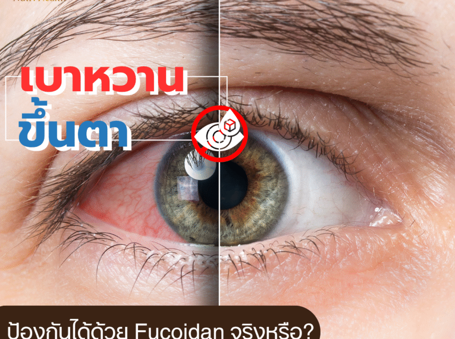 เบาหวานขึ้นตา ป้องกันได้ด้วย Fucoidan จริงหรือ?