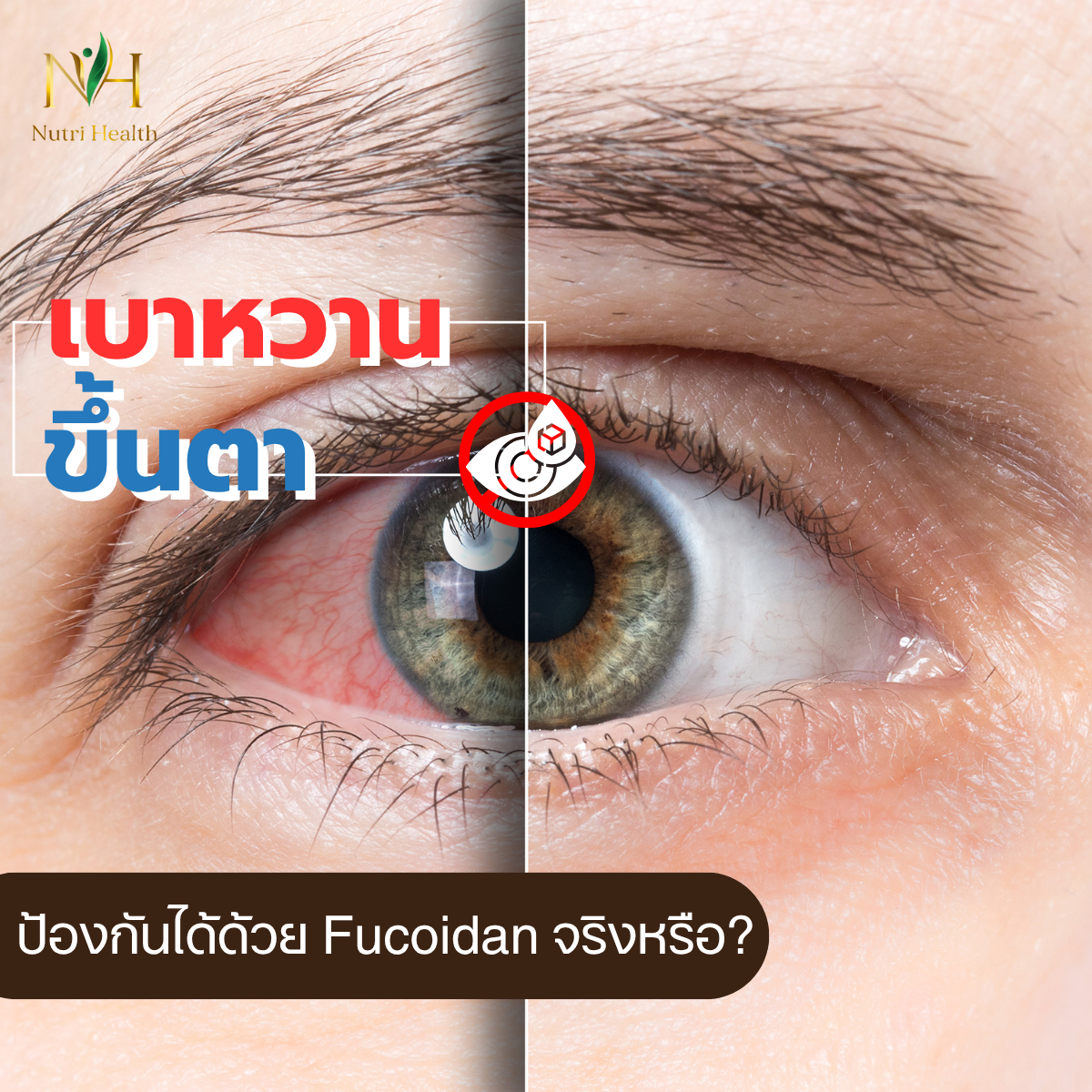 เบาหวานขึ้นตา ป้องกันได้ด้วย Fucoidan จริงหรือ?