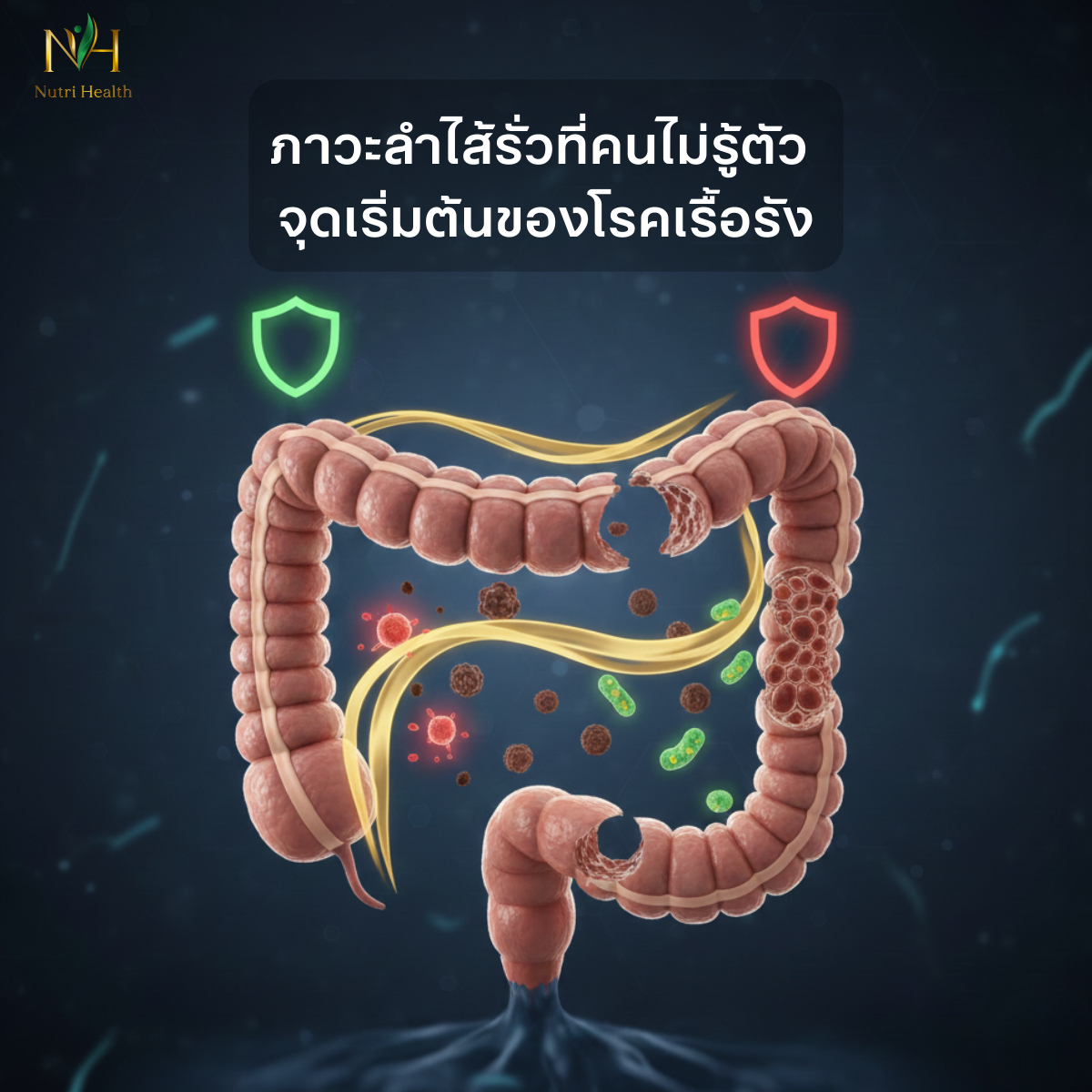 ภาวะลำไส้รั่วที่คนไม่รู้ตัว: จุดเริ่มต้นของโรคเรื้อรัง